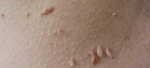 The manner of transmitting HPV