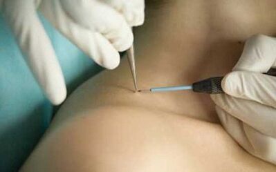 Papile removal methods