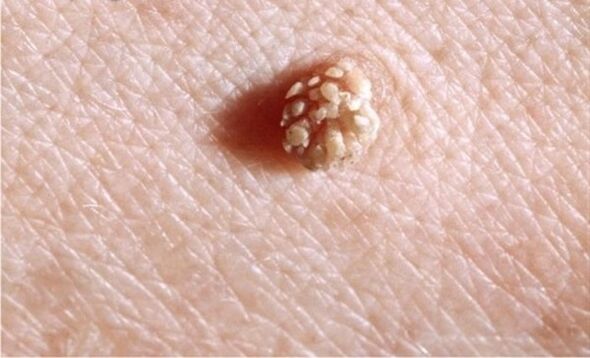 Papilloma