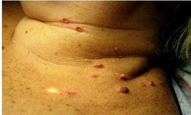 Photos of many papillomes in women