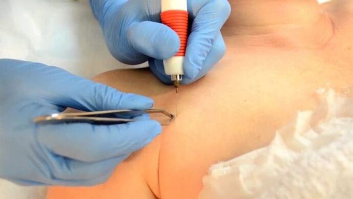 Electrocialagulation - Papile removal method