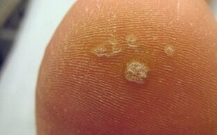 Why plantar warts appear