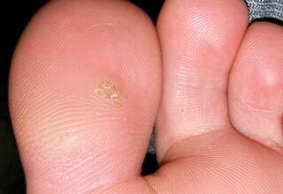 how to get rid of plantar warts