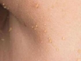 reasons for the appearance of papillomas on the body