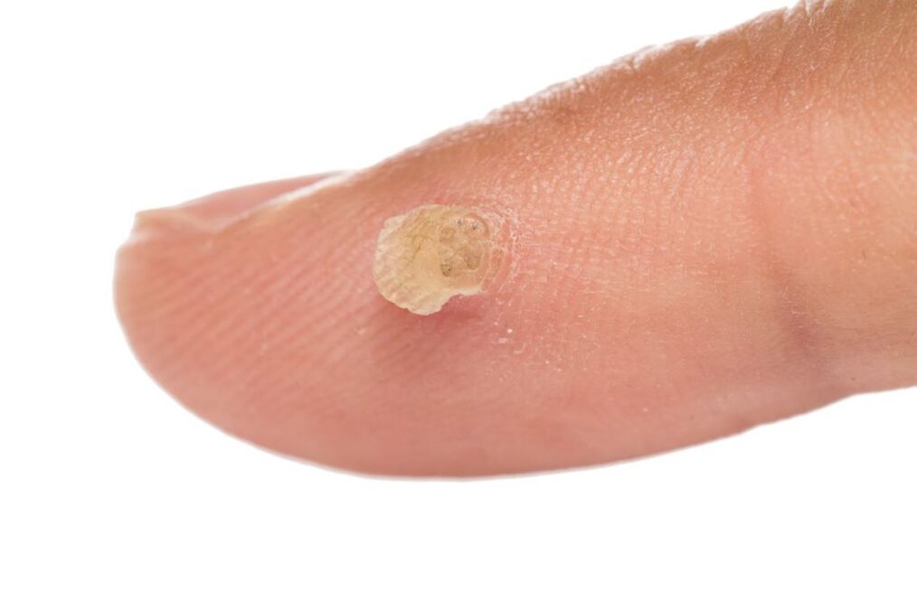 genital warts on the finger