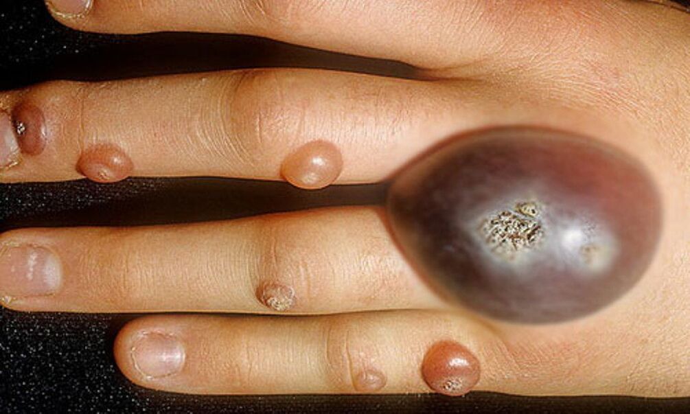 large warts on the arm