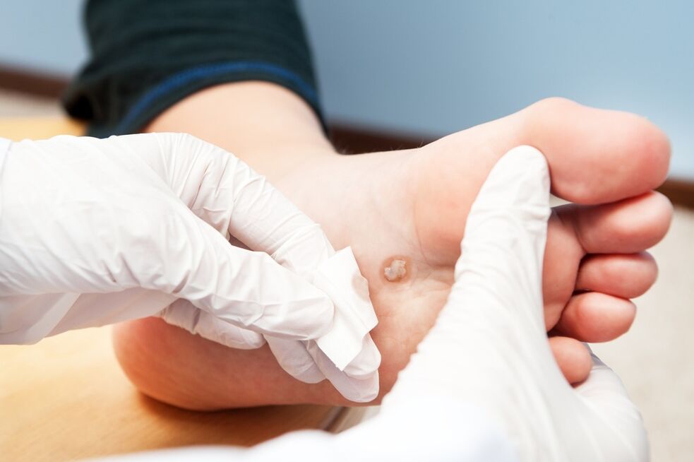 treatment of warts