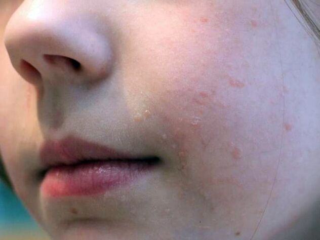 Flat warts on the face most often appear during adolescence