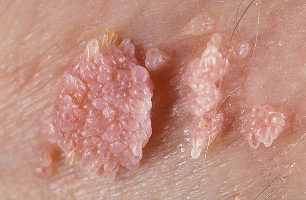 Papilloma is a benign tumor formation of the skin and mucous membrane of a warty nature